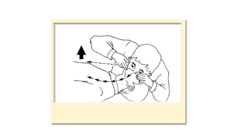 如何进行人工呼吸